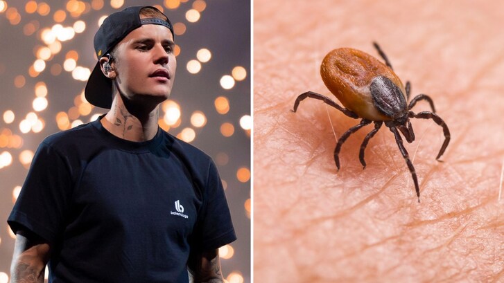 justin bieber zecca malattia lyme